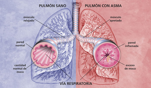 Consejos para prevenir y tratar el asma y la bronquitis enfermedades del sistema respiratorio